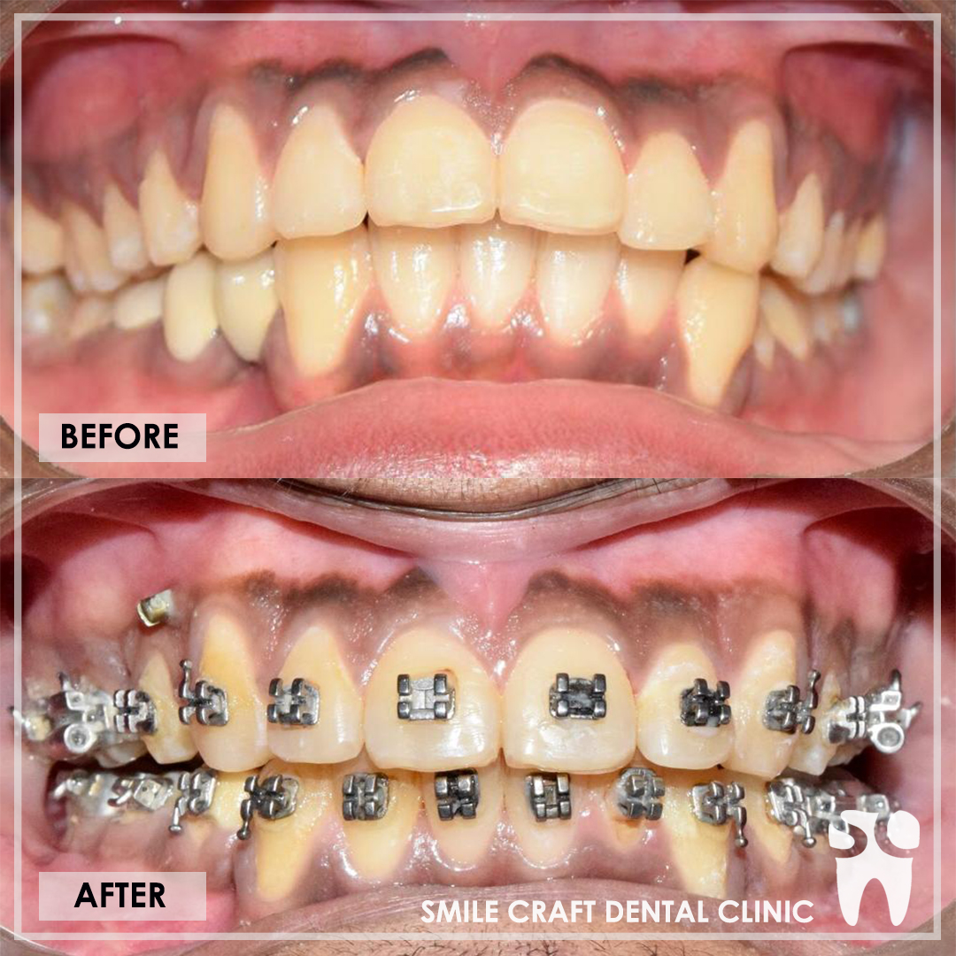 Braces Smile Makeover After