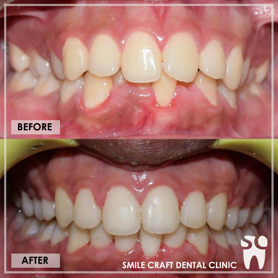 Braces Smile Makeover After