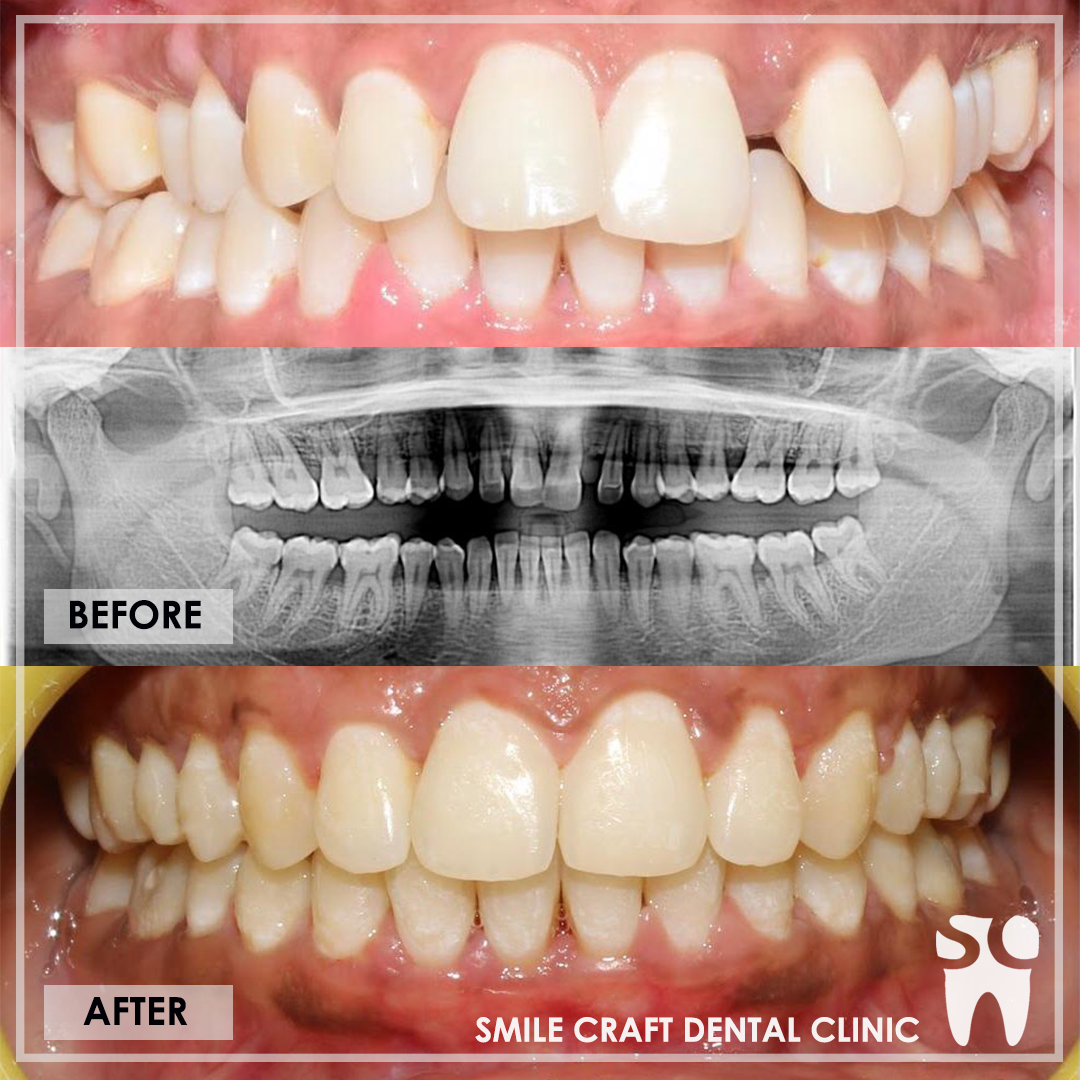 Braces Smile Makeover After