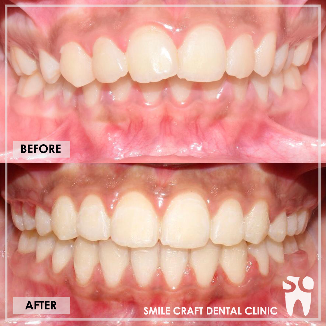 Braces Smile Makeover After