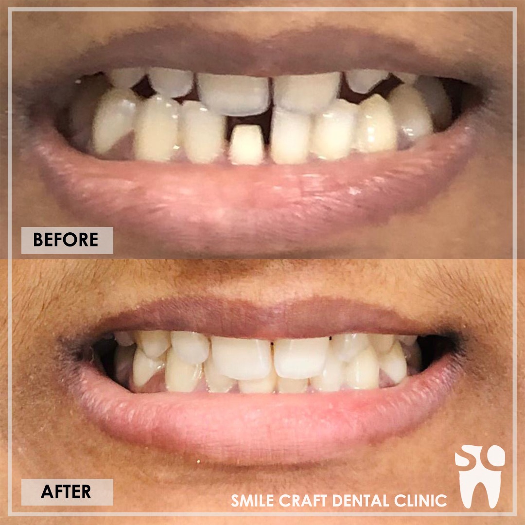 Zirconia Smile Makeover After