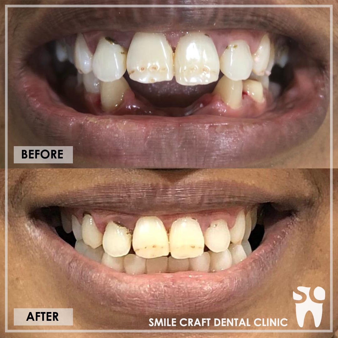 Zirconia Smile Makeover After