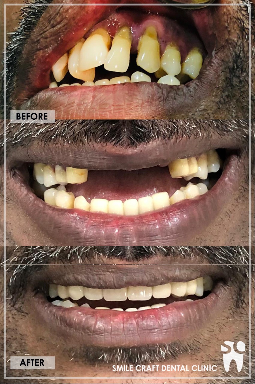 Zirconia Smile Makeover After
