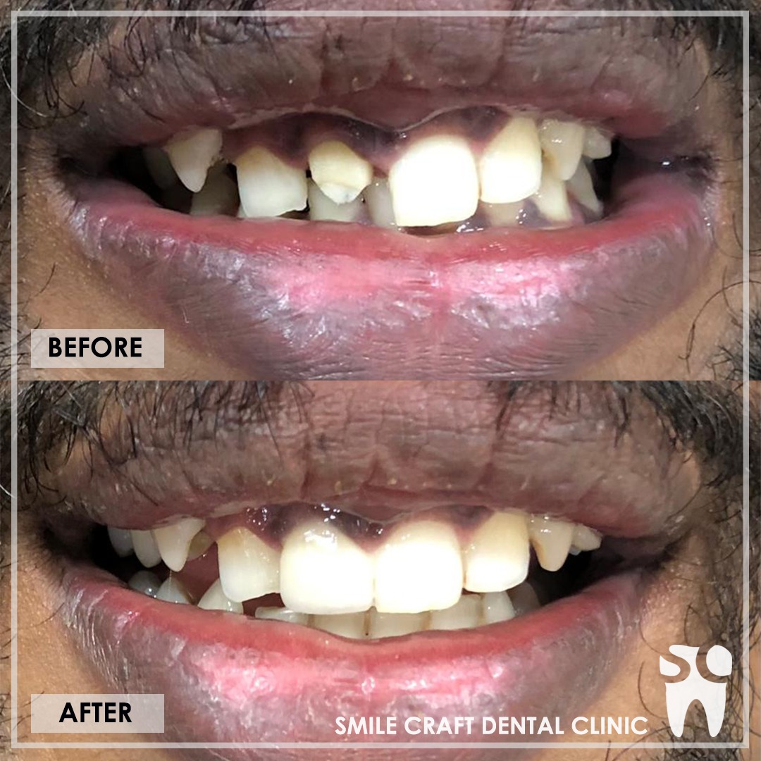 Zirconia Smile Makeover After