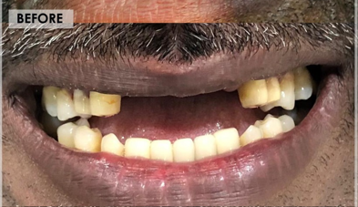 Zirconia Smile Makeover Before